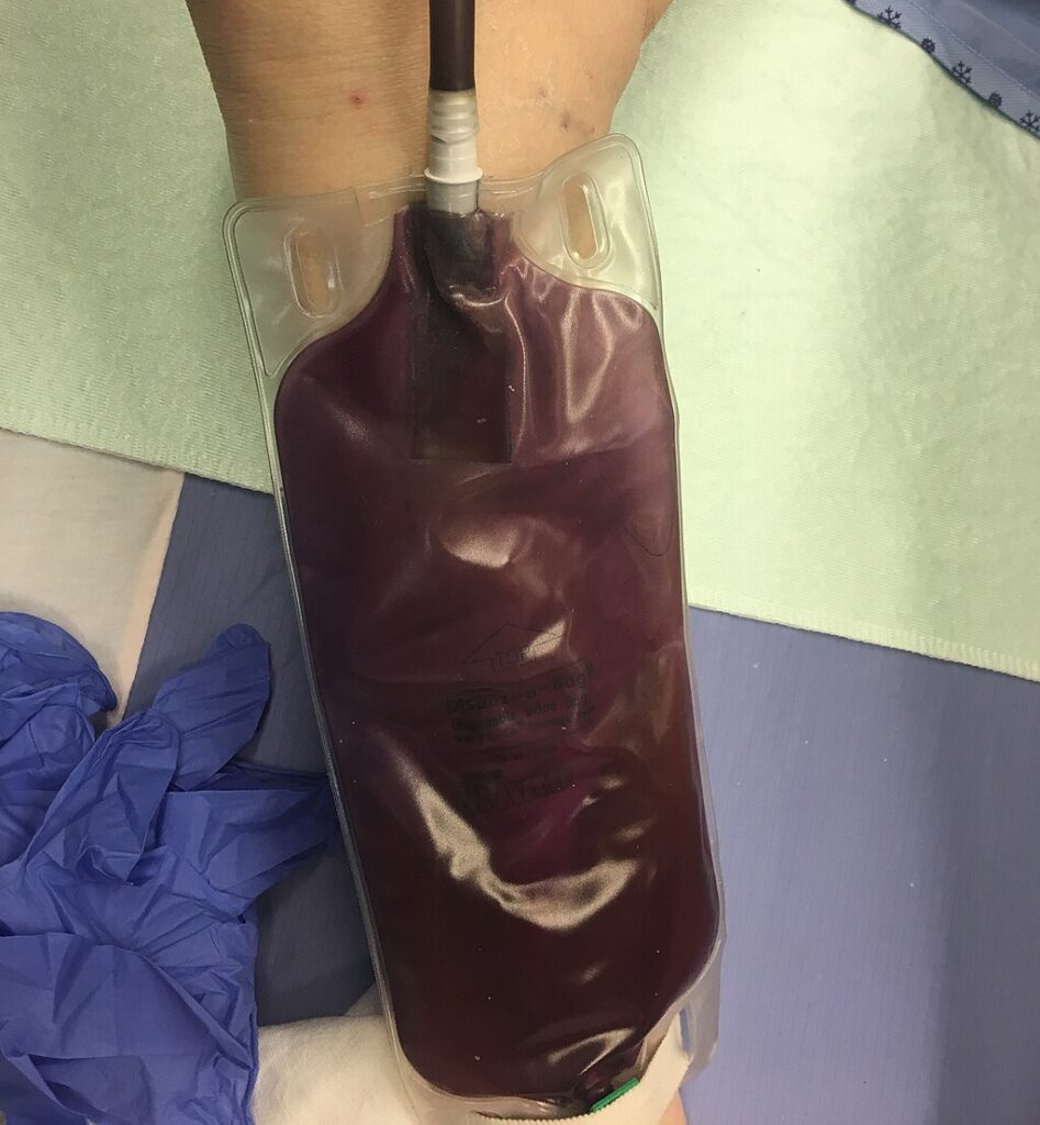 Primjer purpurnog obojenja kod zbirne vrećice urina (purple urine bag syndrome) - James Heilman, MD, CC BY-SA 4.0, via Wikimedia Commons