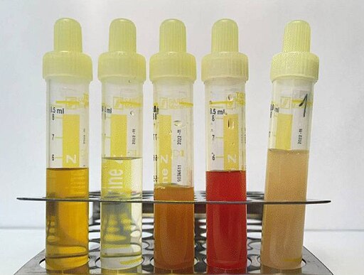 Bacteria in urine: symptoms, treatment and best medicine for urinary tract infections - Lehmann R., CC BY 4.0, via Wikimedia Commons