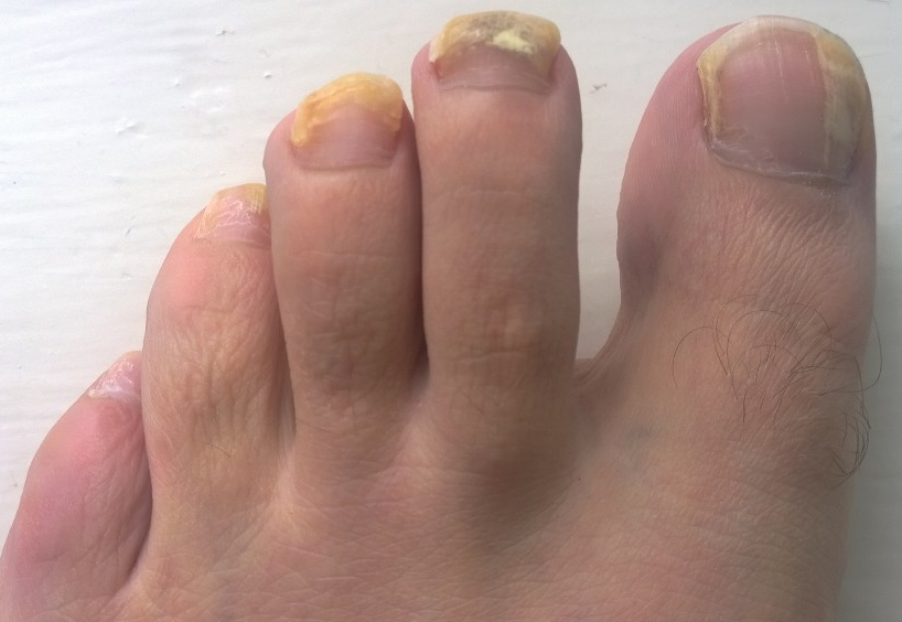 Stanje nakon 10 tjedana oralnog terbinafina - primjer oporavka - Dandandandandandandan2014, CC BY-SA 4.0, via Wikimedia Commons