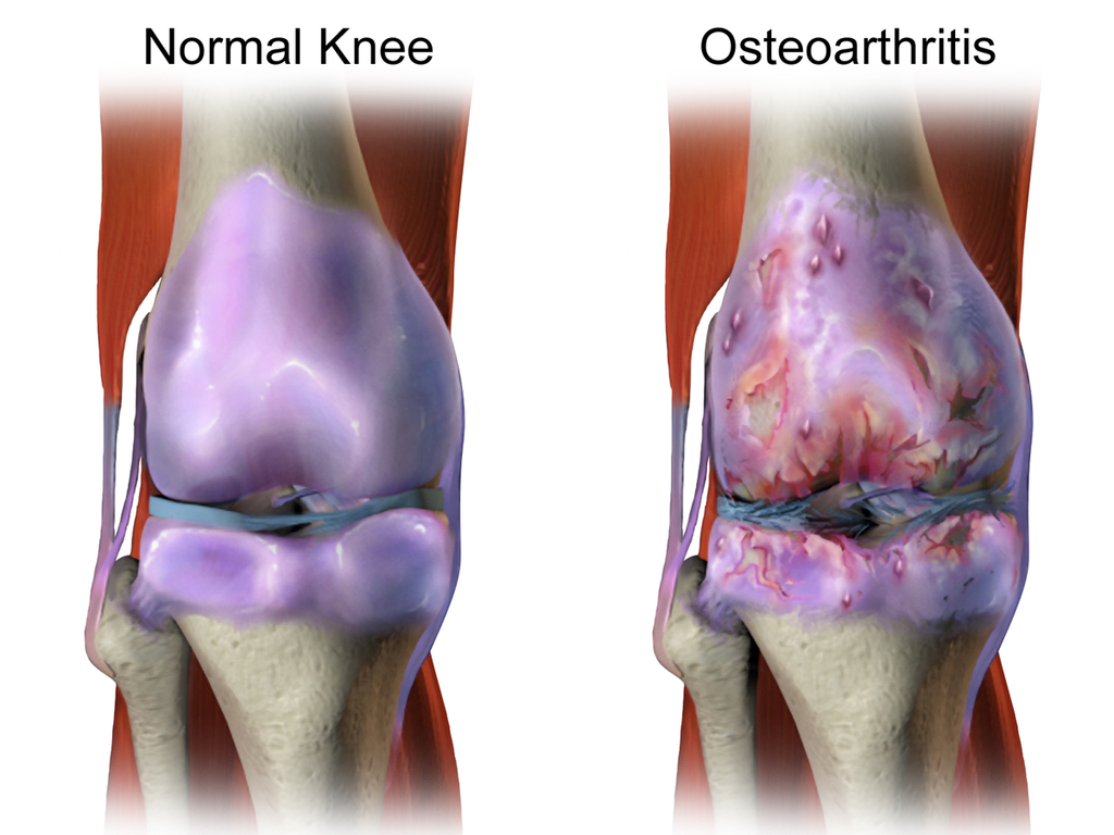 Forbidden foods in arthritis: foods that cause inflammation 3 Knee - normal joint versus osteoarthritis joint - Brucblaus, CC BY-SA 4.0, Via Wikimedia Commons