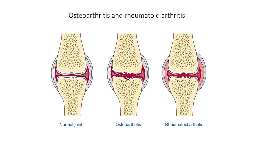 Forbidden foods in arthritis: foods that cause inflammation 6 Diagram: normal joint, osteoarthritis and rheumatoid arthritis - Laboratoires Servier, CC BY-SA 3.0, Via Wikimedia Commons