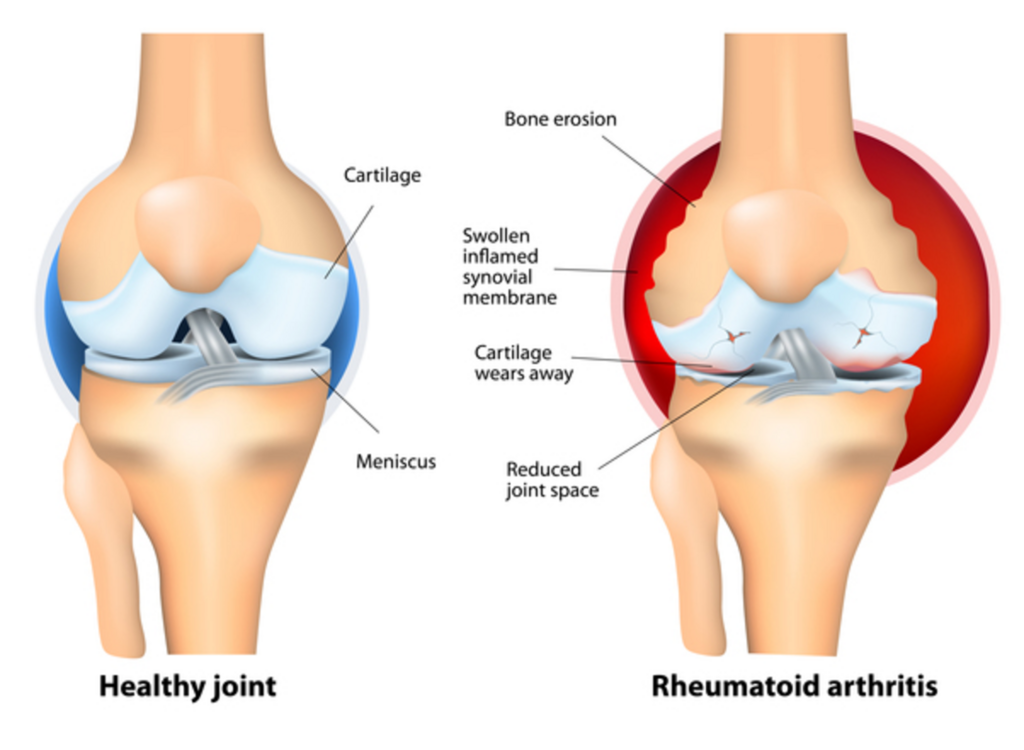 Forbidden foods in arthritis: foods that cause inflammation 4 Normal joint opposite to a joint affected by rheumatoid arthritis - National Library of Medicine US, Public Domain, Via Wikimedia Commons