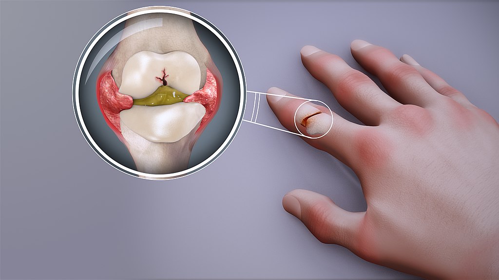 Forbidden foods in arthritis: foods that cause inflammation 5 Inflamed synovial layer in the finger joint in rheumatoid arthritis - www.scientificanimations.com, CC BY-SA 4.0, Via Wikimedia Commons
